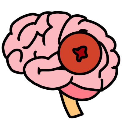 a brain with a small dark red impact shape on it and an orange circle around the impact shape.
